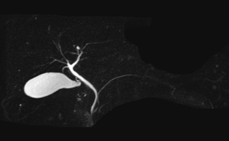 MRCP（磁気共鳴胆管膵管撮影）の画像
